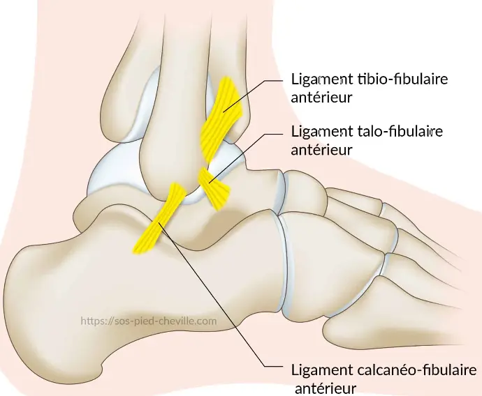 Schéma simplifié d'une entorse de cheville – inversion et ligaments latéraux