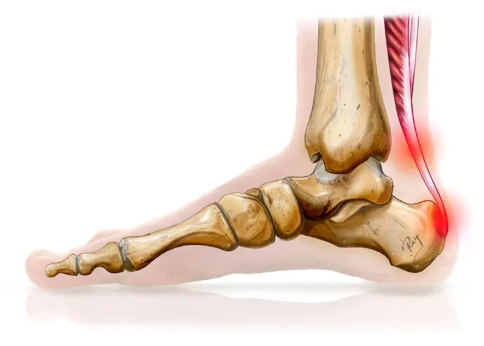 Tendinopathie d’Achille – anatomie et zones douloureuses